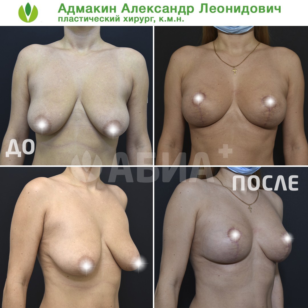 отзывы женщин о подтяжке груди фото 63