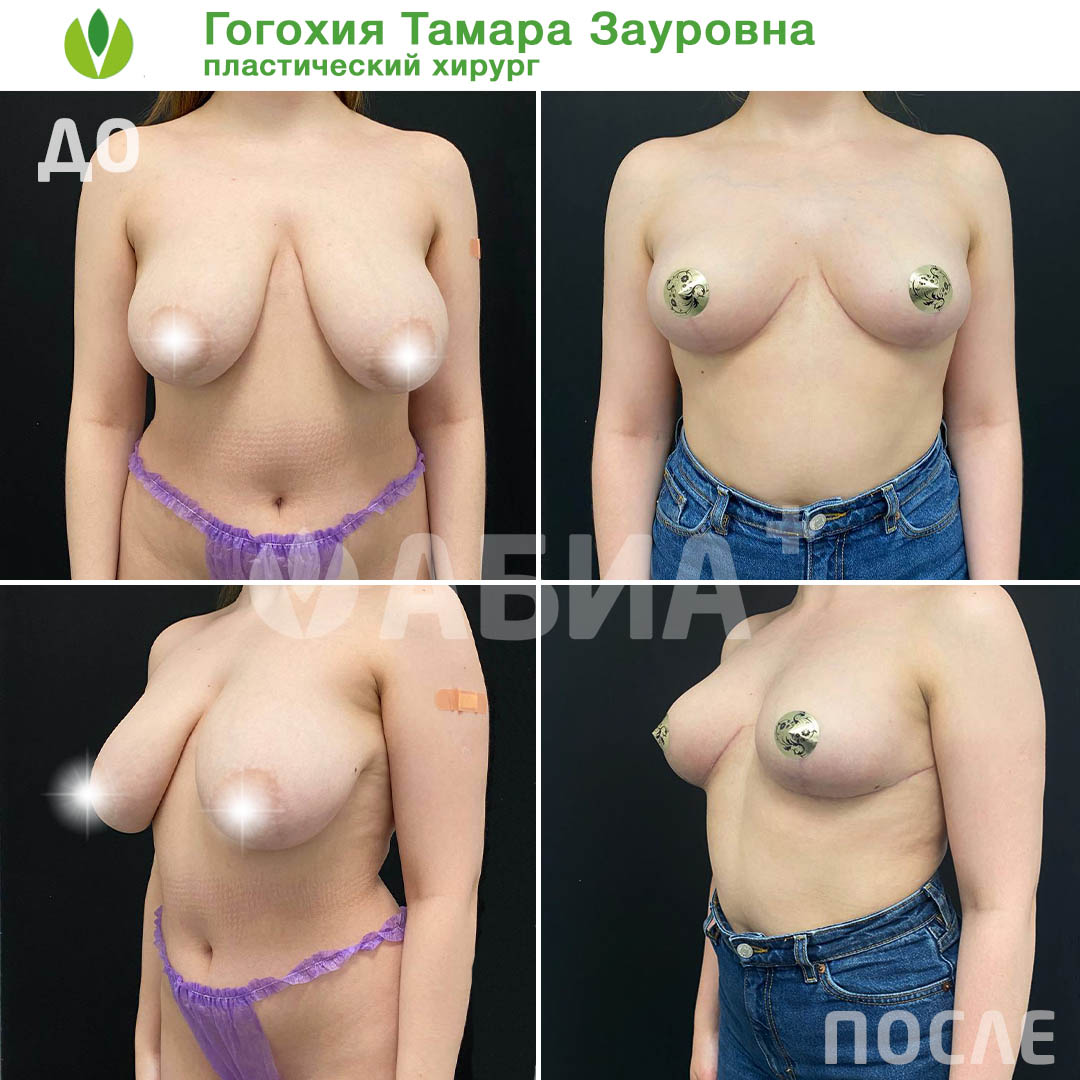 как проходит операция по уменьшению груди у женщин фото 55