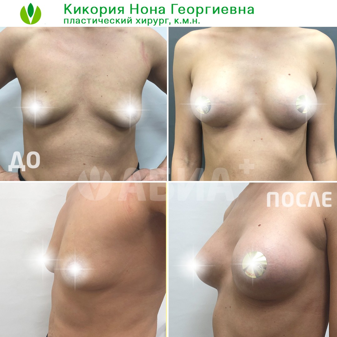 увеличивается грудь с возрастом у женщин фото 106