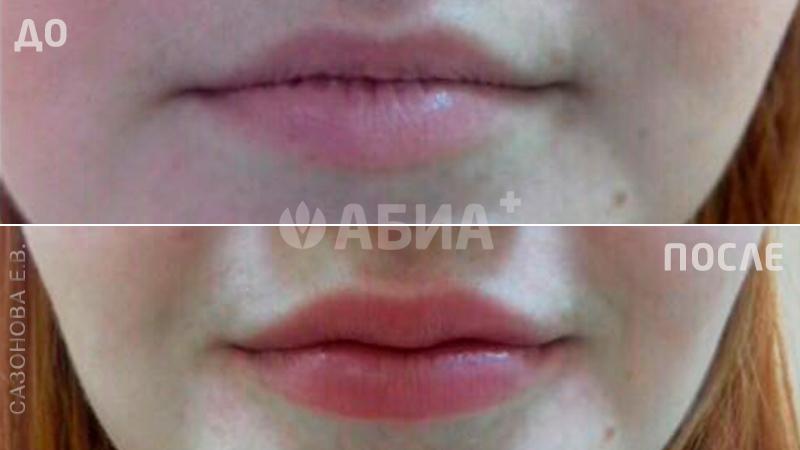 Контурная пластика губ гелем Regenyal Idea Lips