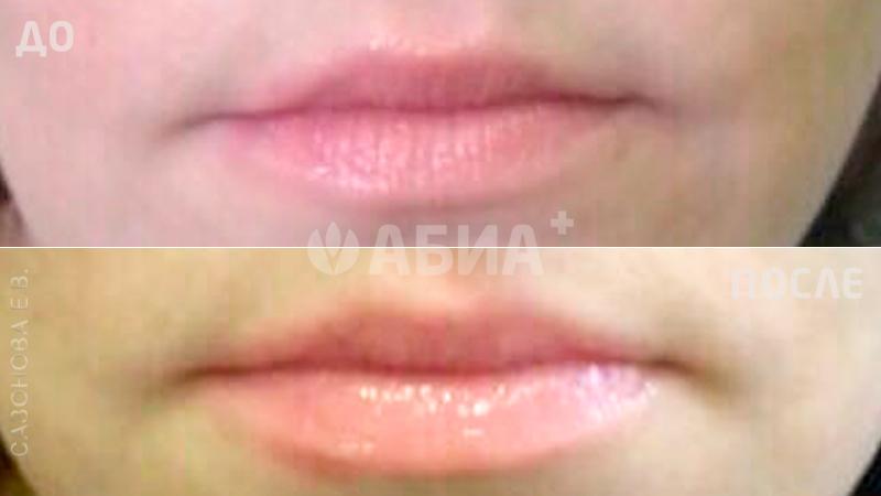 Контурная пластика губ гелем Regenyal Idea Lips