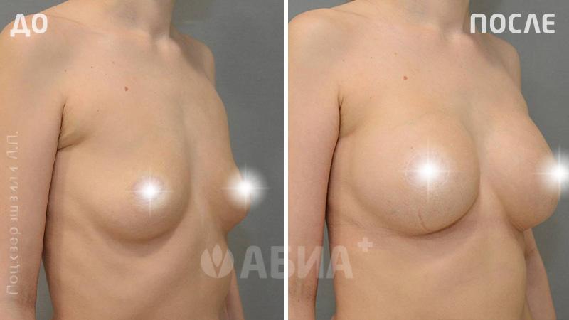 Периореалярная подтяжка груди на импланте