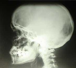 Обзорная краниограмма. Пациентка 38 лет. Выявлена аномалия Киммерле (врожденный порок развития первого шейного позвонка). Клиника 