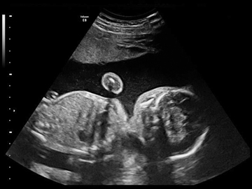 УЗИ скриниг второго триместра беременности
