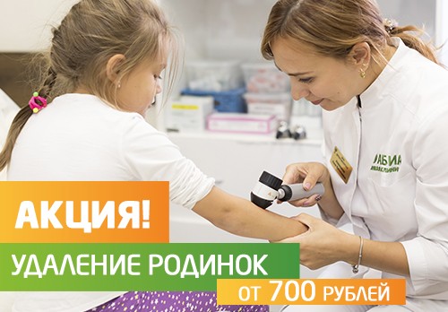 Удаление родинок от 700 рублей
