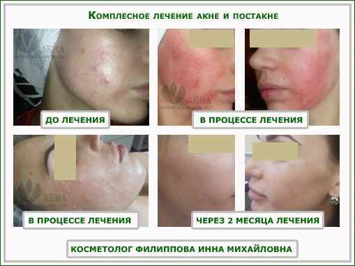 Комплексное лечение акне