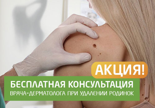 Удаление родинок